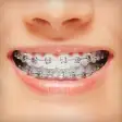 Braces