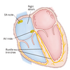 Cardiac Arrhythmia &amp; Treatment