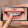 Braces photo editor